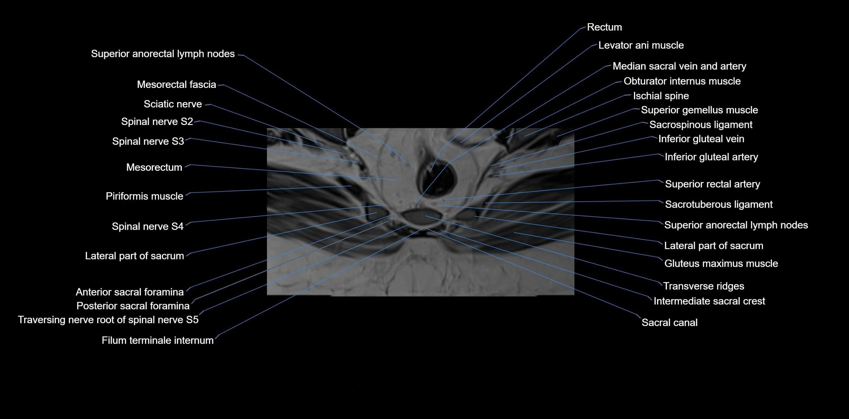 MRI sacrum, coccyx and sacroiliac joint axial cross sectional anatomy 3T  radiology  image-img-00001-00053.webp